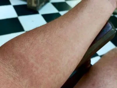 Cuba enfrenta grave epidemia de enfermedades transmitidas por mosquitos