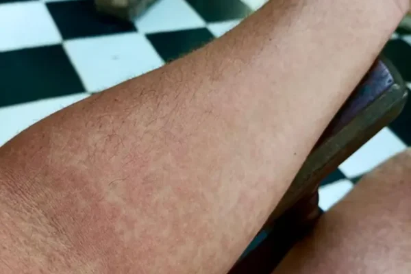 Cuba enfrenta grave epidemia de enfermedades transmitidas por mosquitos