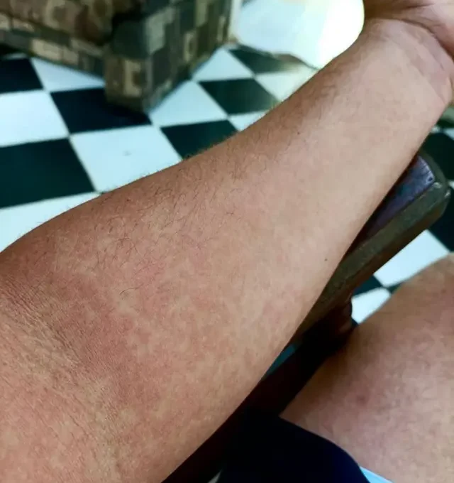 Cuba enfrenta grave epidemia de enfermedades transmitidas por mosquitos